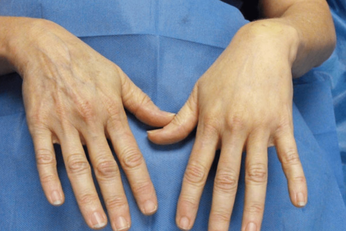 Patient's hands before and after hand fat grafting