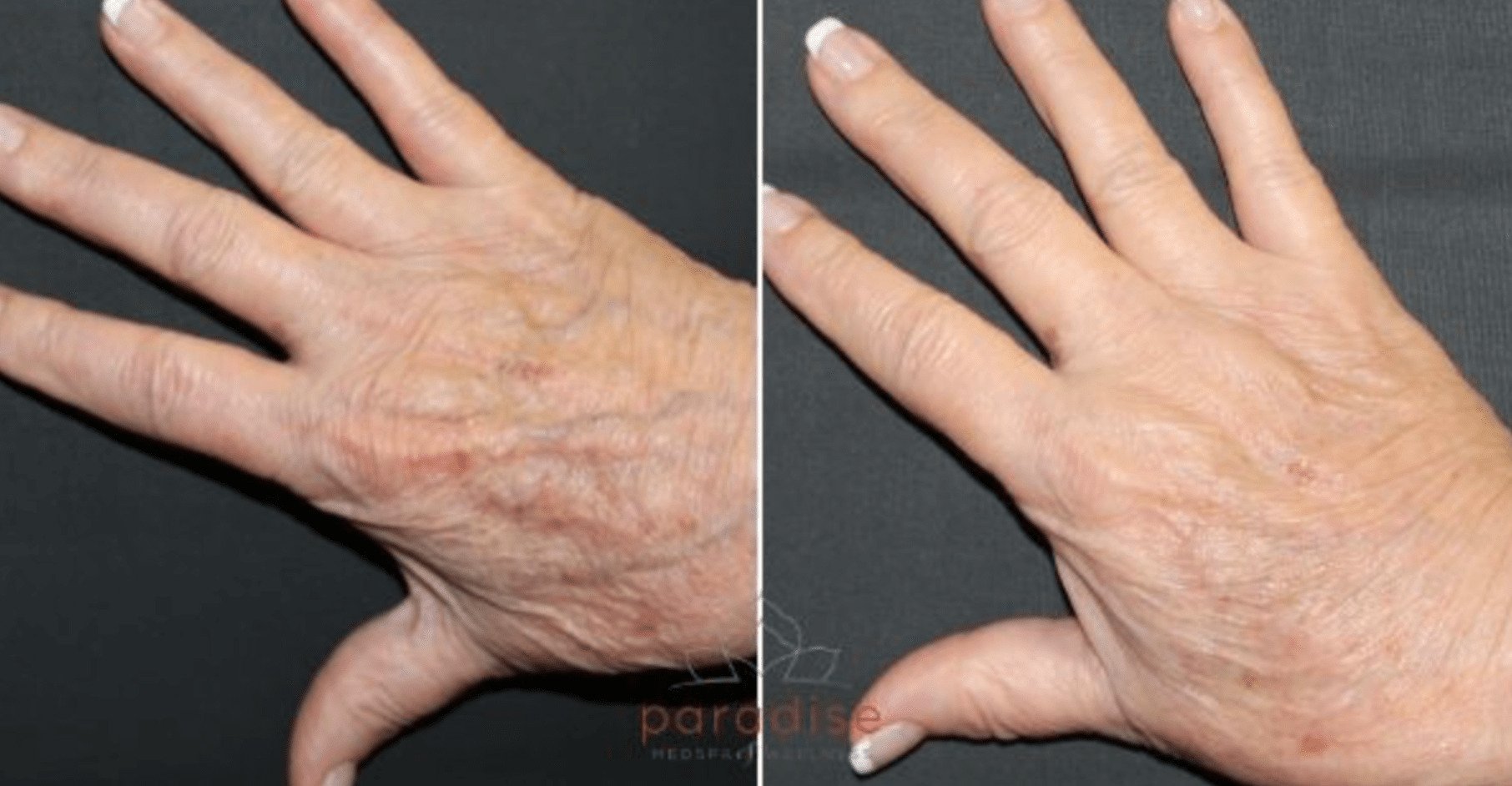 Patient's hands before and after hand fat grafting