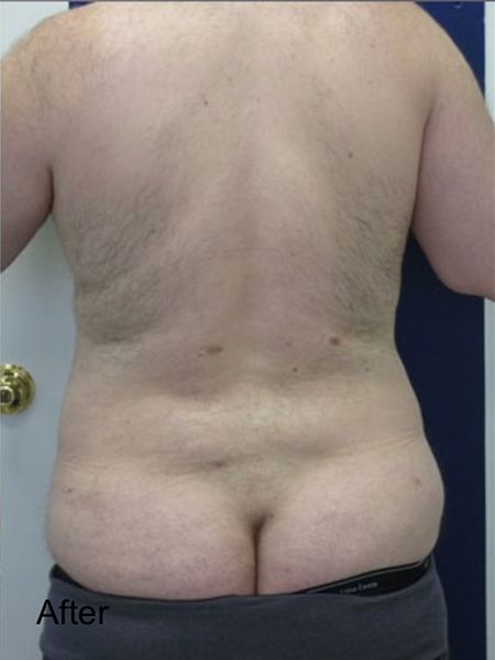 Patient after Hips Lipo Procedure