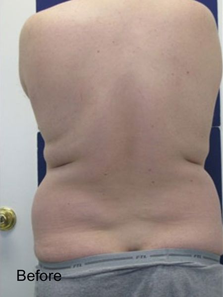 Patient before Hips Lipo Procedure