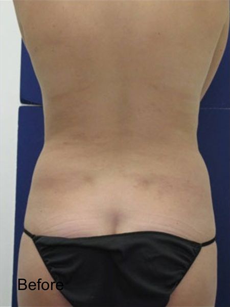 Patient before Hips Lipo Procedure