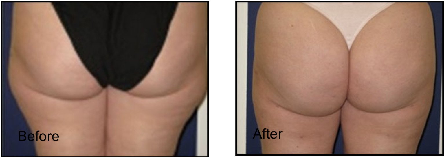 Female patient before and after hips lipo