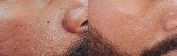 Male patient before and after Botox® treatment for acne and large pores