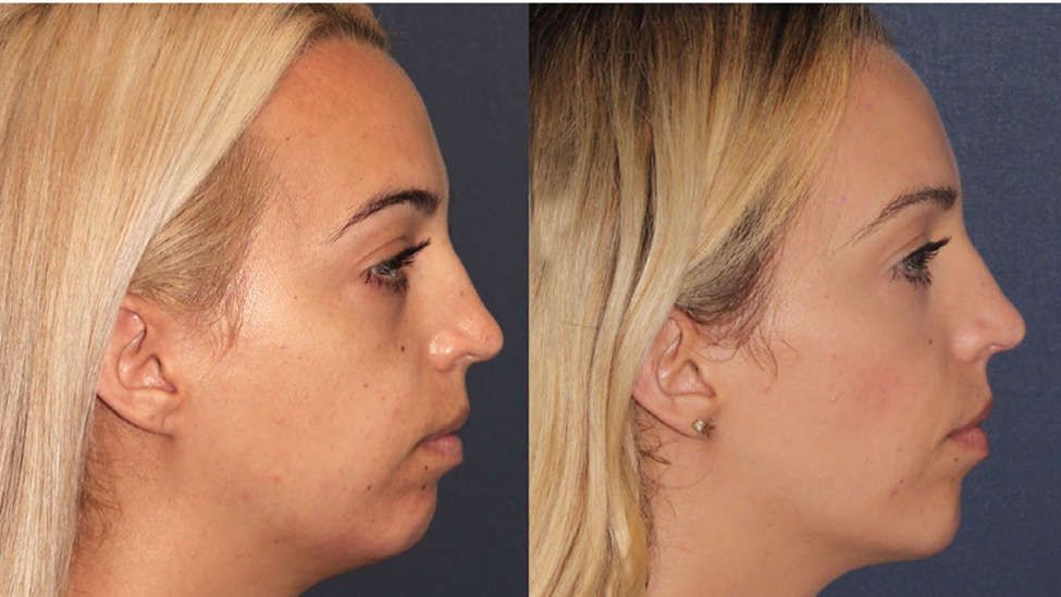 Face profile of a woman before and after chin enhancement and lower face contouring procedure
