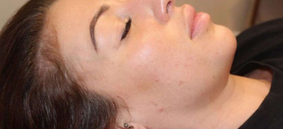 Patient before Non-Surgical Lower Face Lifting and Jaw Contouring