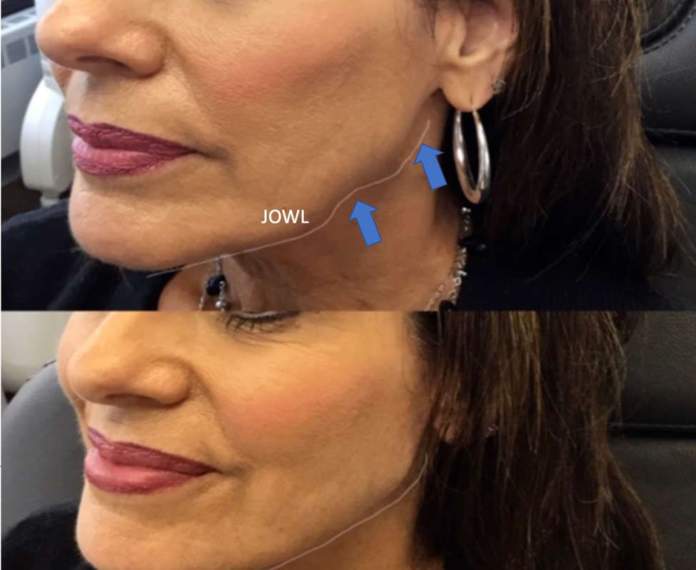 Mature woman's jawline before and after non-surgical jowls treatment 