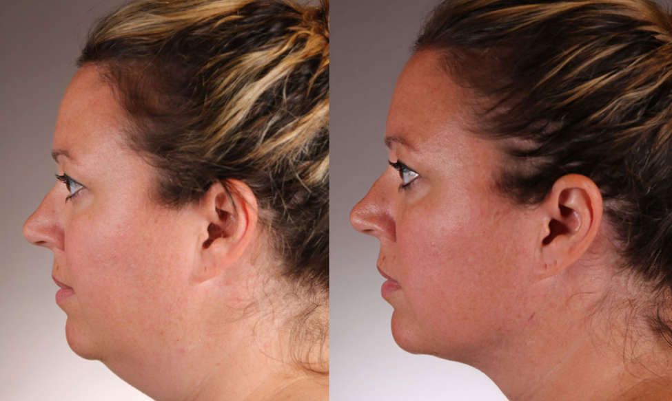 Profile of a woman before and after non-surgical chin fat removal and jawline contouring treatment 