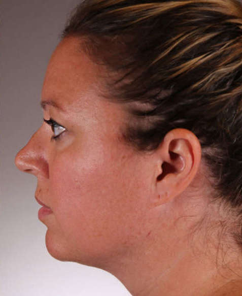 Patient after Non-Surgical Lower Face Lifting and Jaw Contouring