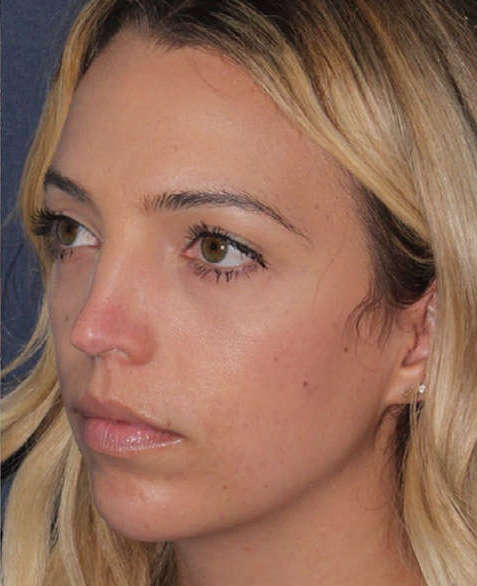 Patient after Non-Surgical Lower Face Lifting and Jaw Contouring
