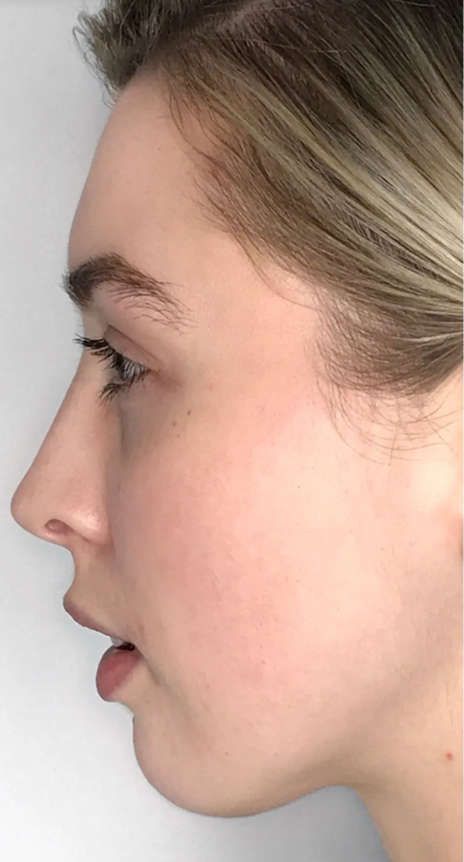 Patient before Non-Surgical Lower Face Lifting and Jaw Contouring