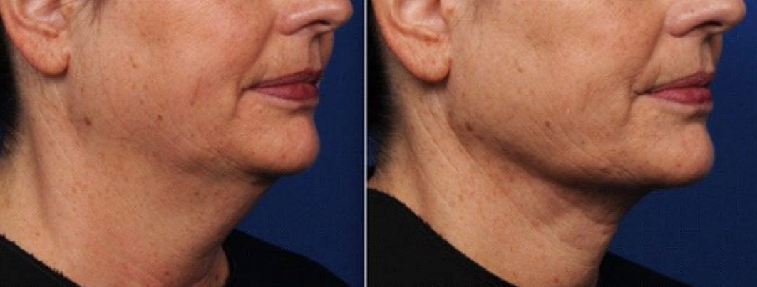 Patient's neck and lower face before and after non-surgical neck lift and jowls treatment.