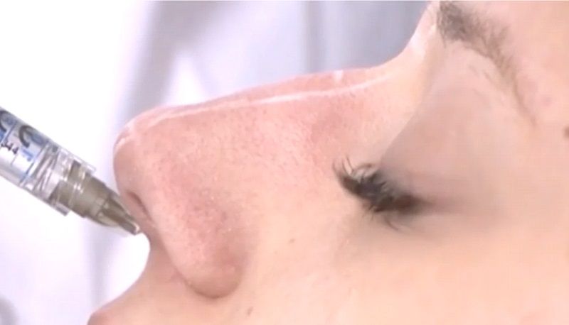 Non-surgical injectable nose job 