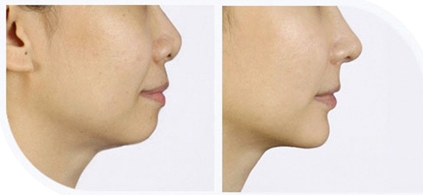 Profile of a man before and after receding jaw treatment