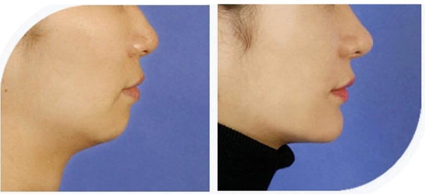 Profile of a woman before and after receding jaw treatment