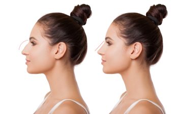 woman nose before and after procedure