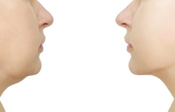 woman face before and after procedure