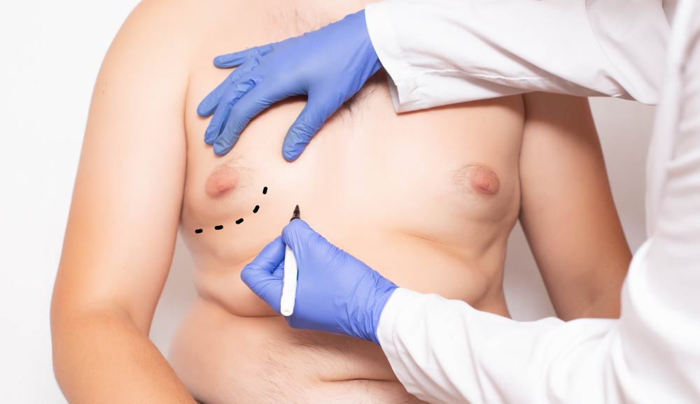 l-glutathione man boobs 🥇 Male Breast Lipo: A Noninvasive Treatment for gluthiathone