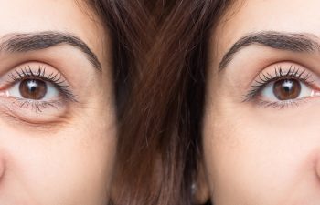woman eye before and after procedure