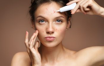 young woman with acne on the face