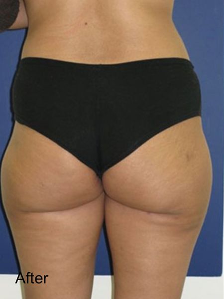 Patient after Thighs ang Hips Lipo Procedure