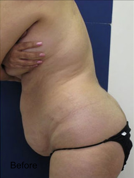 Patient before Tummy Lipo Procedure