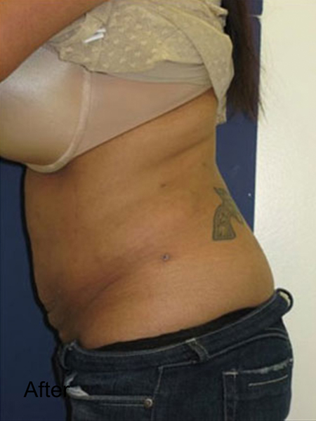 Patient after Tummy Lipo Procedure