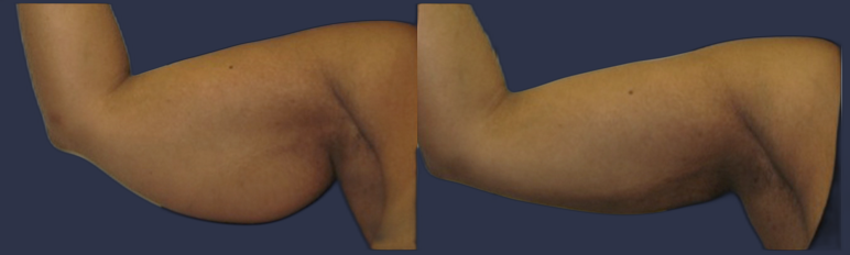 Female patient before and after SmartARMLift ™