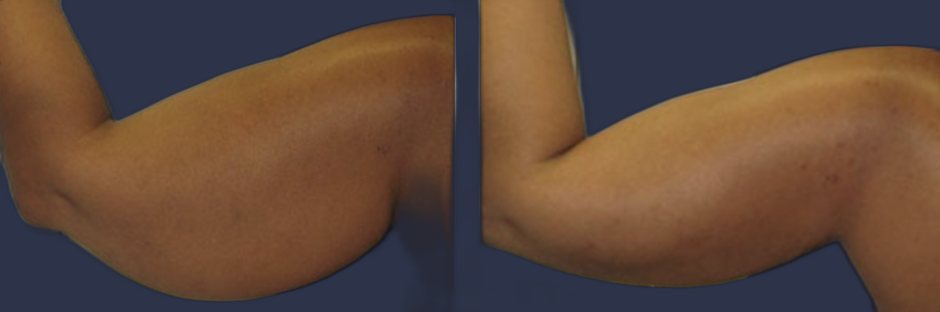Female patient before and after SmartARMLift ™