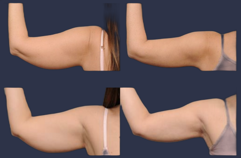 Female patient before and after SmartARMLift ™