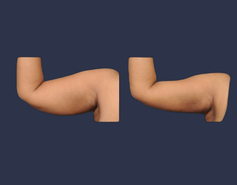 Female patient before and after SmartARMLift ™